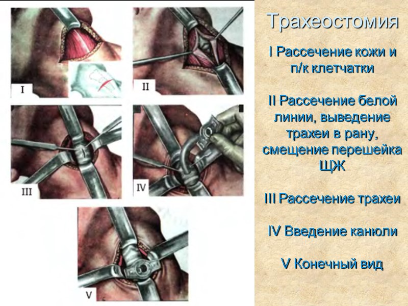 Трахеостомия I Рассечение кожи и п/к клетчатки  II Рассечение белой линии, выведение трахеи